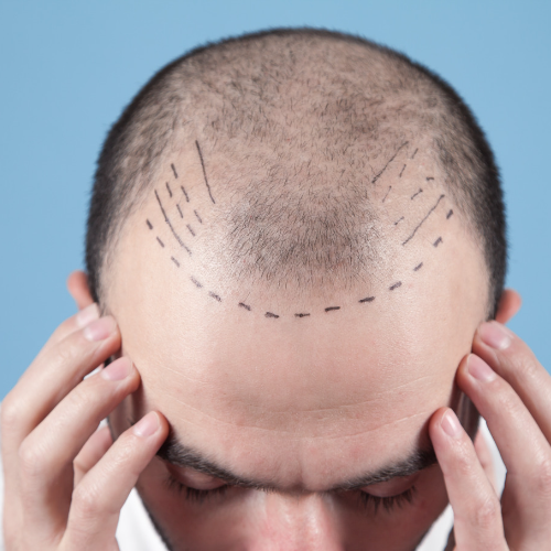 Managing Hair Fall Naturally with Homeopathy: Expert Tips from Dr. A K Mishra