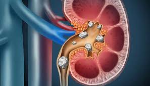 Causes of kidney stones — dehydration, diet, infections and metabolism explained by Dr A K Mishra, Gorakhpur