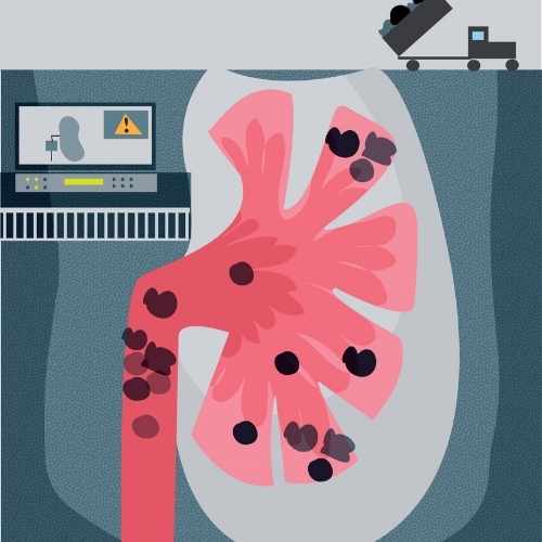Illustration of a kidney with stones — homeopathic kidney stone treatment in Gorakhpur