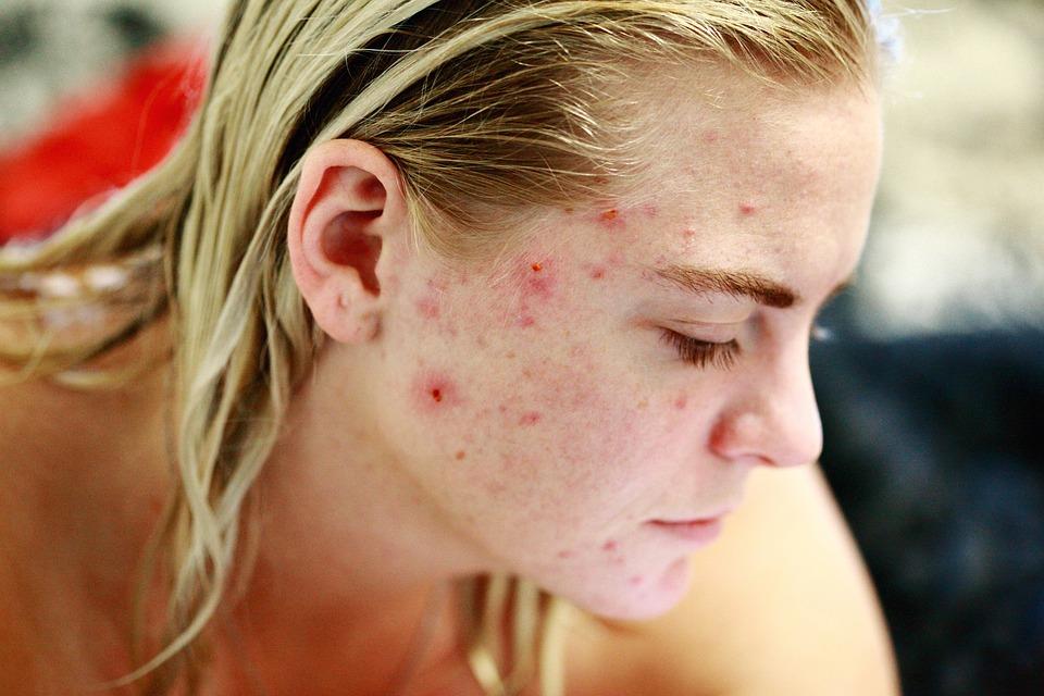 Skin Acne Treatment at Dr A K Mishra's Homeopathy Centre Gorakhpur