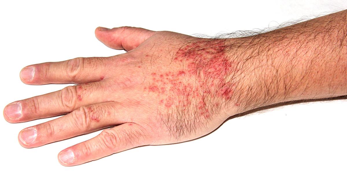Skin allergic dermatitis Treatment at Dr A K Mishra's Homeopathy Centre Gorakhpur