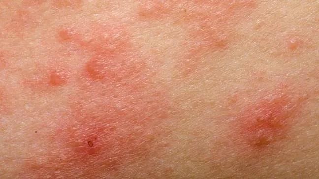 Skin Eczema Treatment at Dr A K Mishra's Homeopathy Centre Gorakhpur