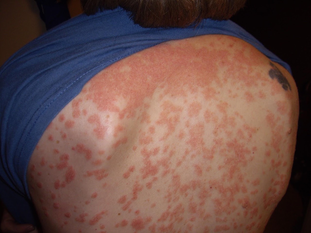 Skin psoriasis Treatment at Dr A K Mishra's Homeopathy Centre Gorakhpur