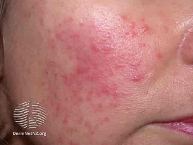 Skin Rosacea Treatment at Dr A K Mishra's Homeopathy Centre Gorakhpur
